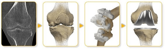 Dr Stenings knee surgical technique