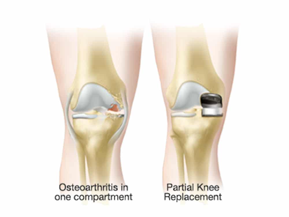 knee surgery sydney