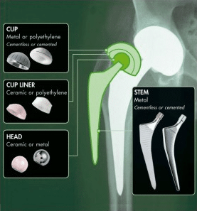 Management of Hip Joint Disease