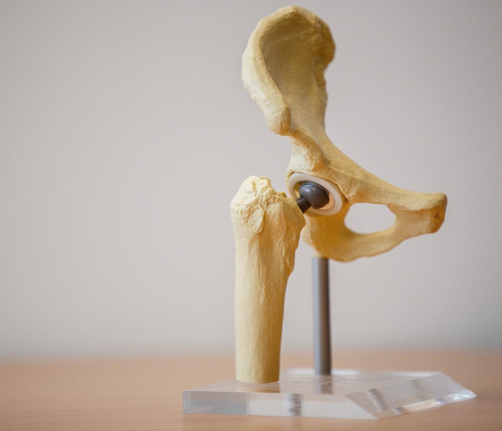 Optimised positioning system (OPS) in total hip replacement