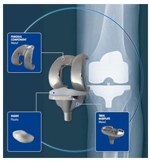 Total knee replacement