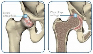 Types of hip joint disease