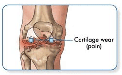 Who develops knee conditions